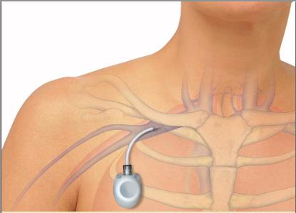 Porta Cath y su Localización: Región Pectoral por acceso de V. subclavia